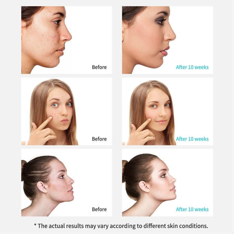 Xpreen Rechargeable Pore Cleanser Home Facial Beauty Device with LED Screen & 4 Probes, XPRE111 - Shello's Creative Boutique