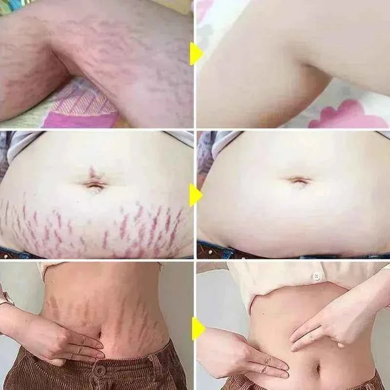 Maternity Stretch Mark Permanent Removal cream Brighten Anti-Winkle Smooth Repair Firming Restore Skin Elasticity Body Skin Care